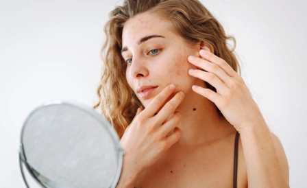 фото девушки с избытком андрогенов