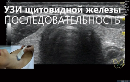 УЗИ щитовидной железы Последовательность УЗИ щитовидной железы.