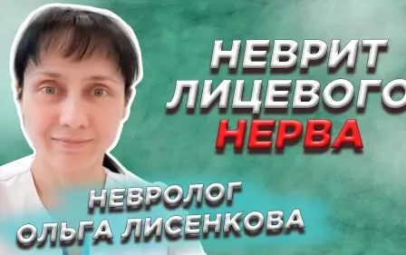 Неврит лицевого нерва.